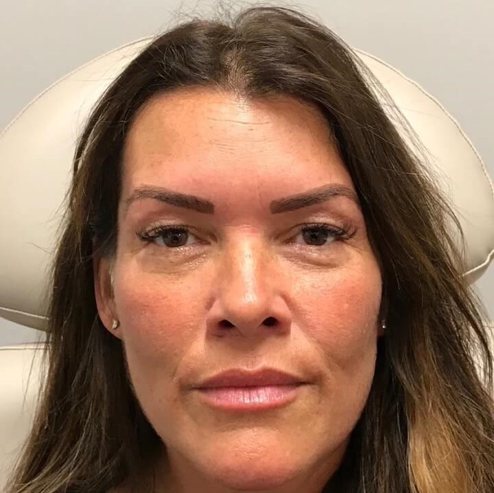 Juvederm Facial Rejuvenation After