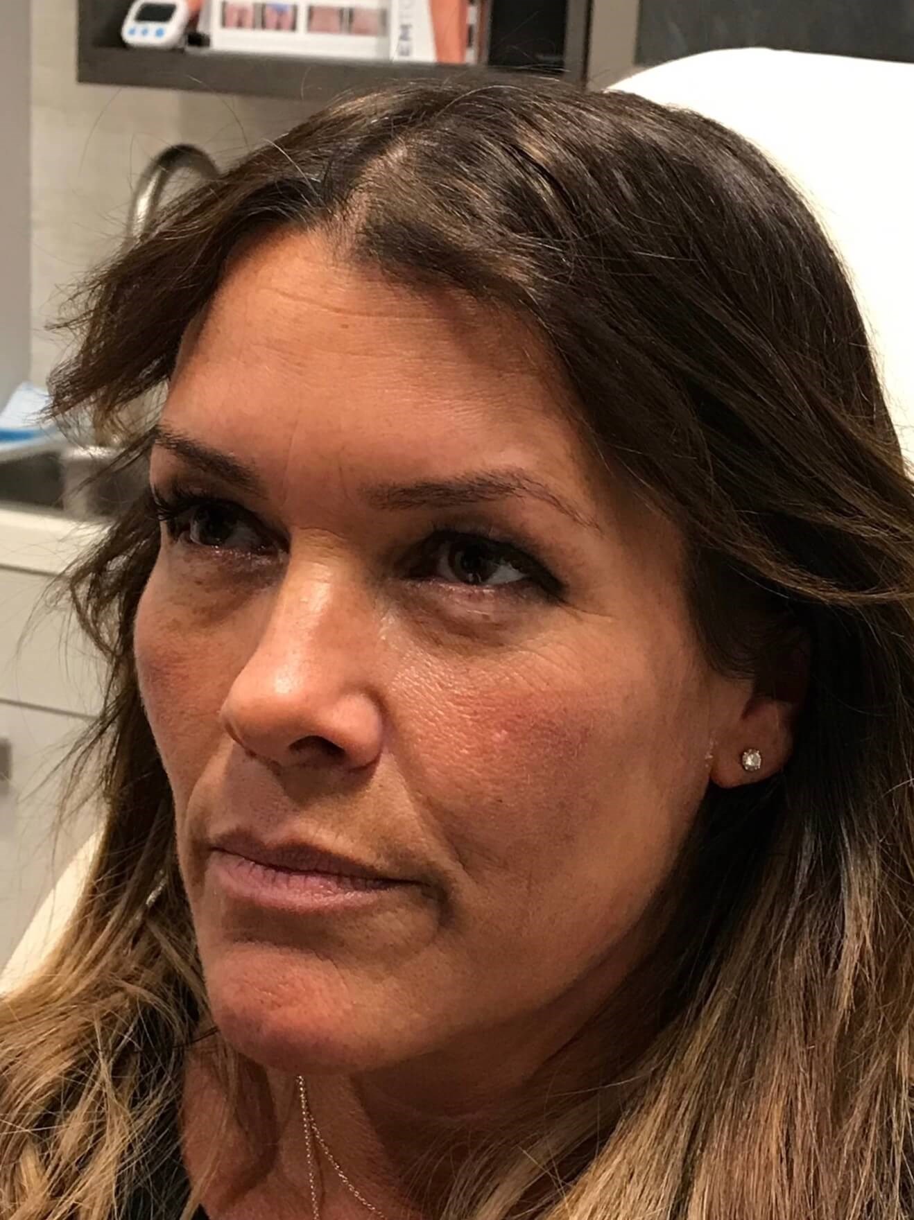 Juvederm Facial Rejuvenation Before