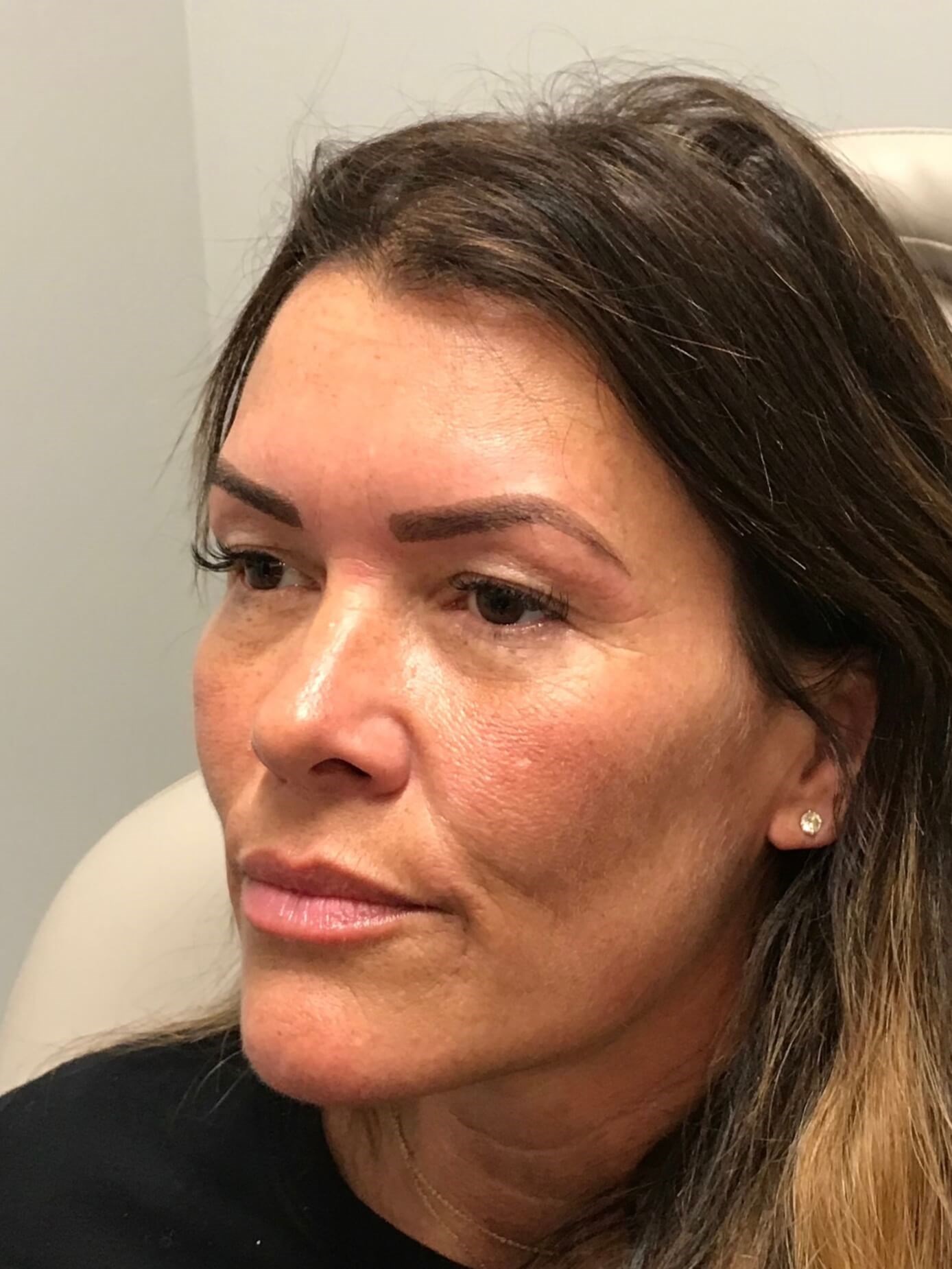 Juvederm Facial Rejuvenation After