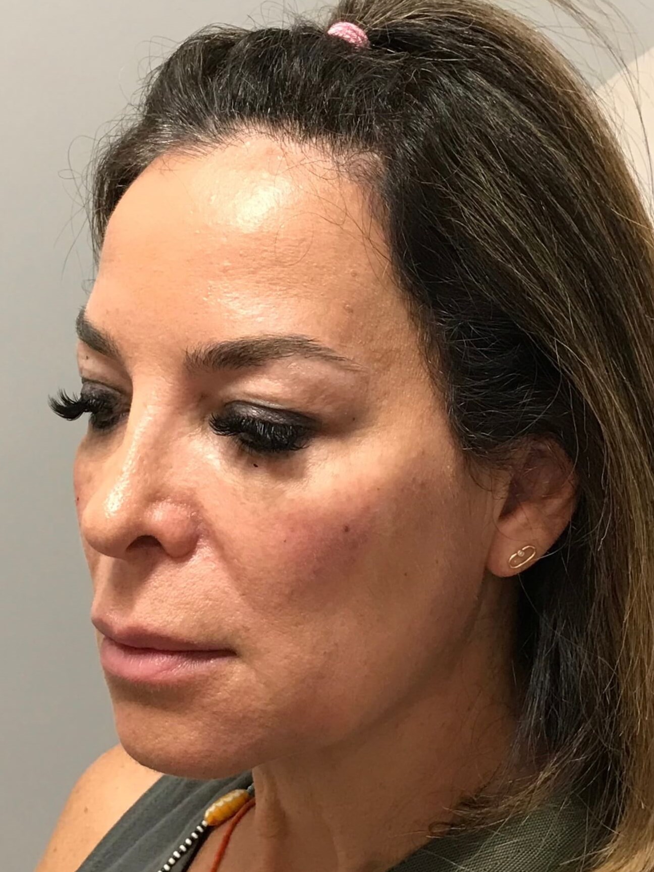 Juvederm Face Rejuvenation After