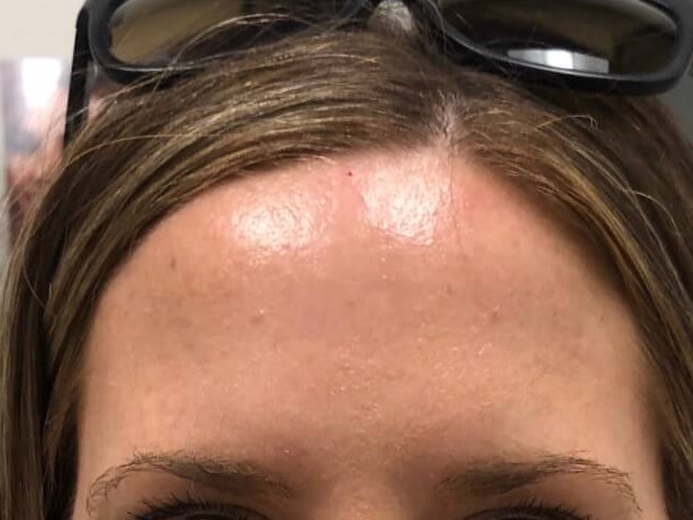 Botox Forehead Lines After