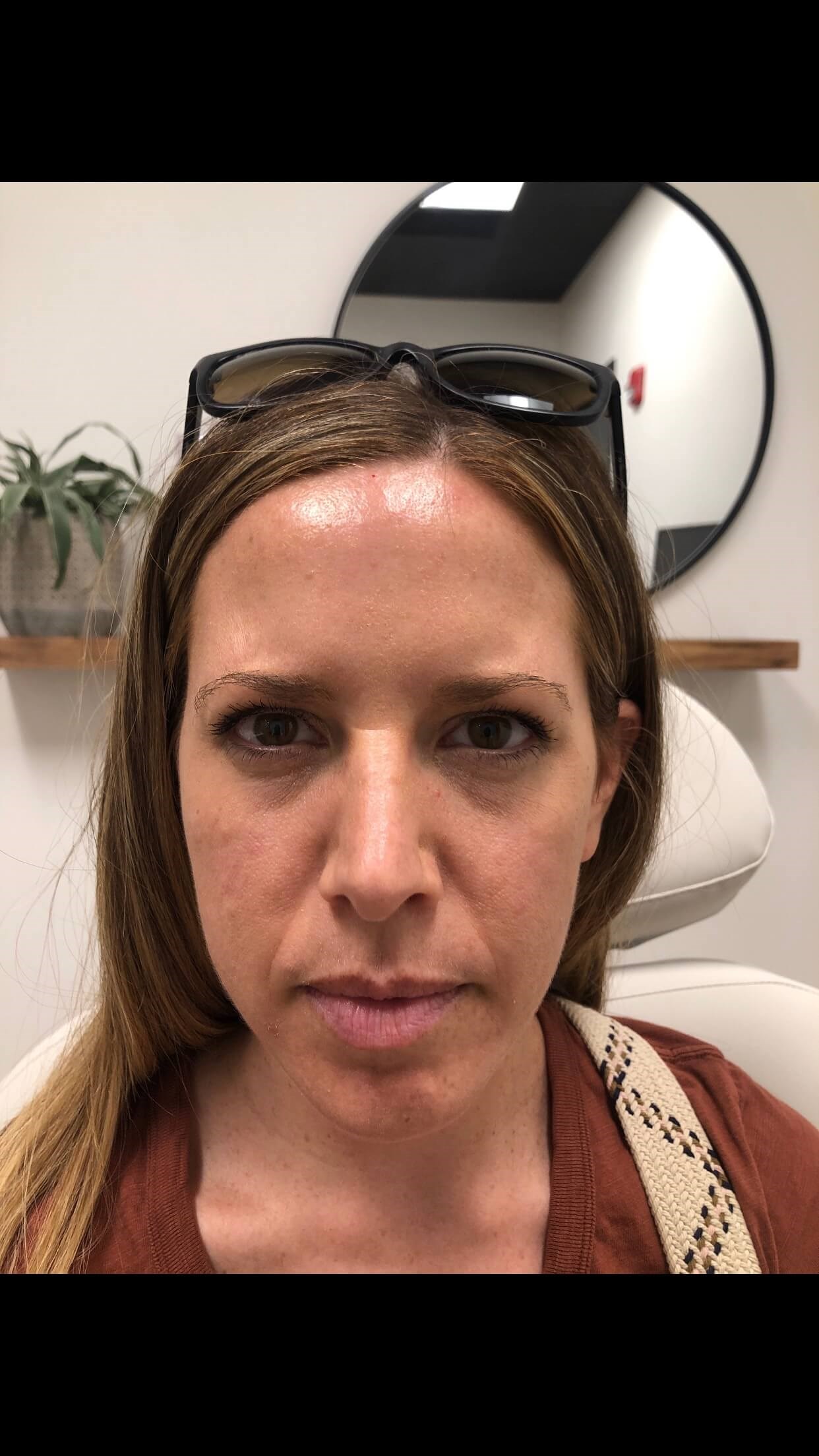 Botox number 11 between brows After