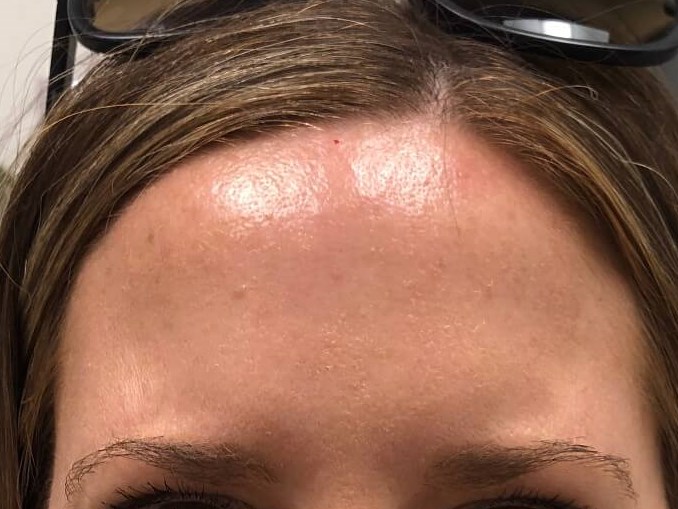 Botox number 11 between brows After