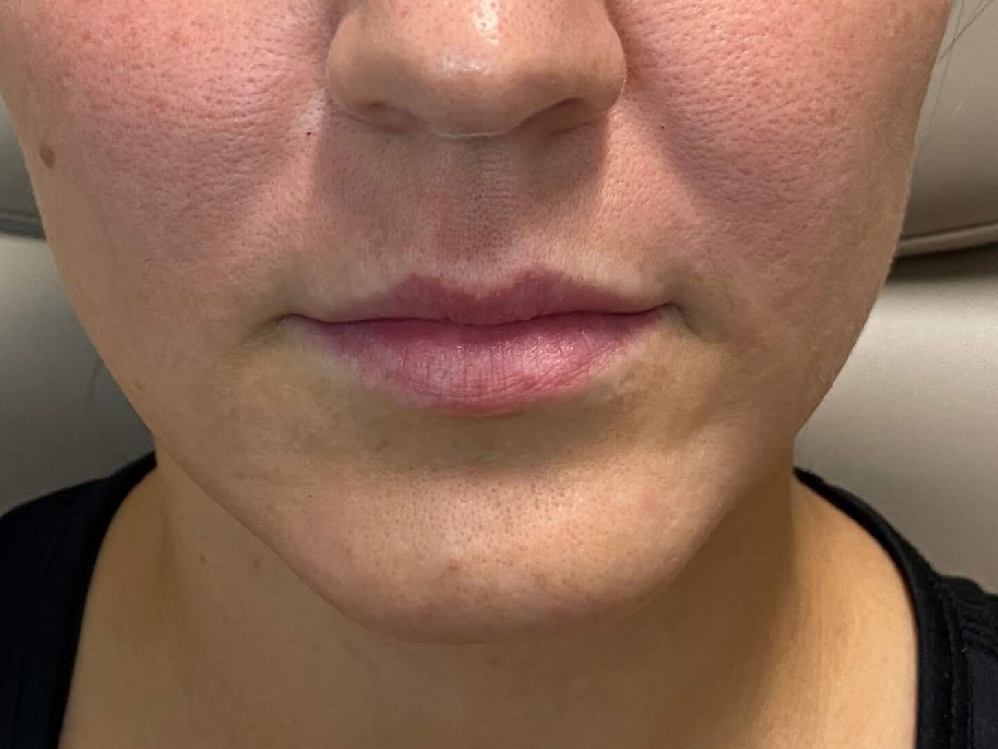 Juvederm Lip Enhancement Before