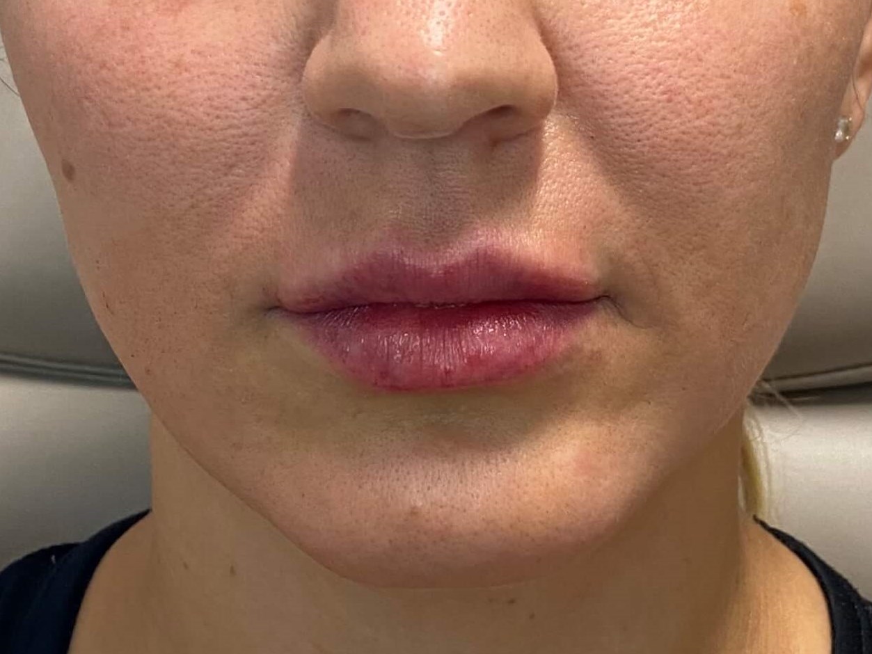 Juvederm Lip Enhancement After