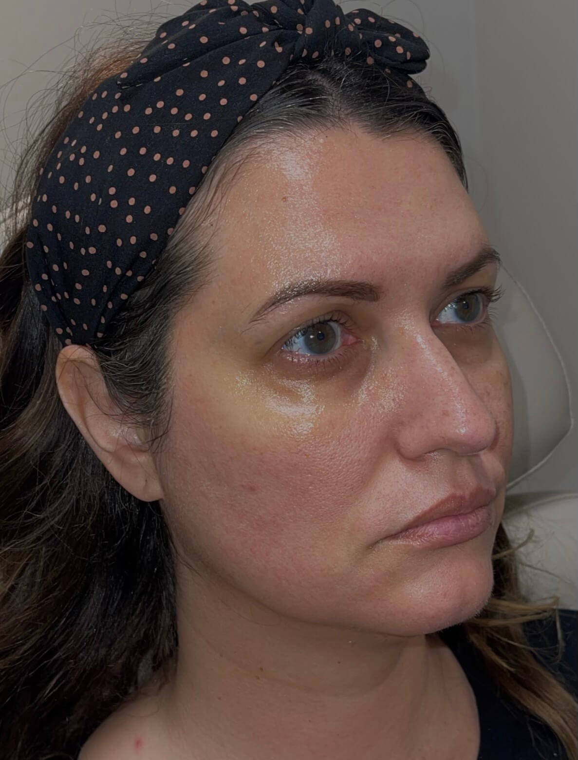 Nonsurgical Face Rejuvenation Before