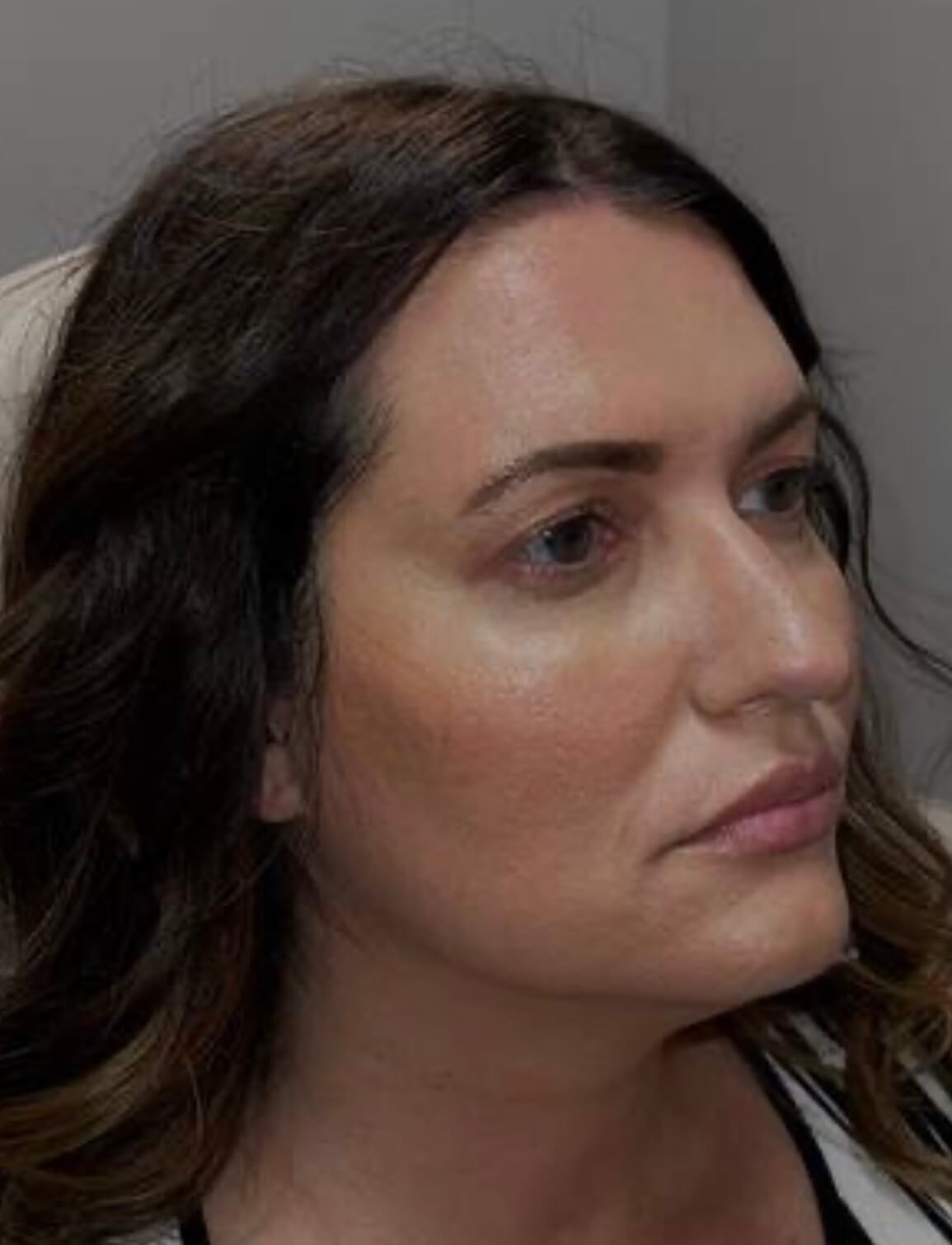 Nonsurgical Face Rejuvenation After