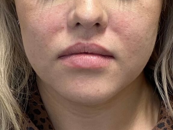 Juvederm Lip Enhancement Before