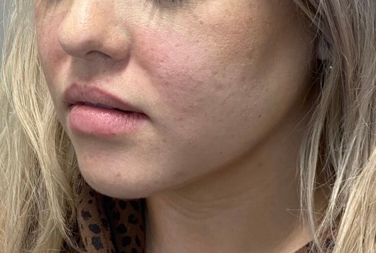 Juvederm Lip Enhancement Before