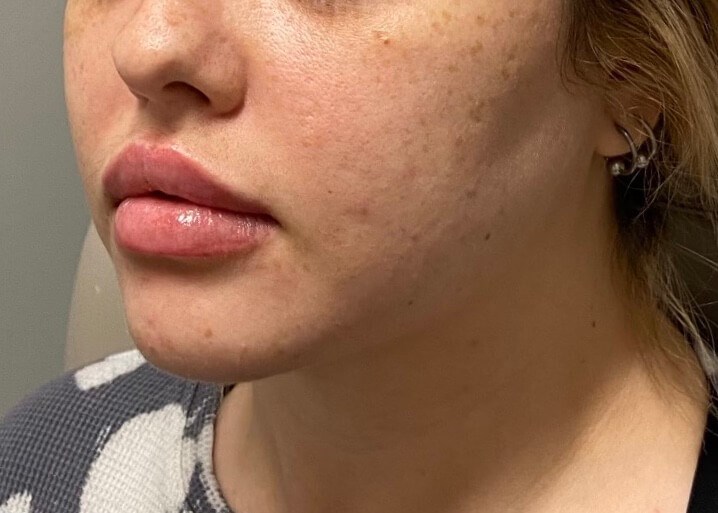 Juvederm Lip Enhancement After