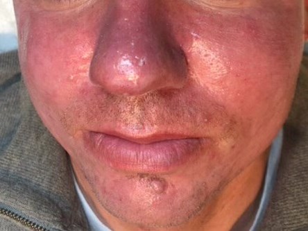 BBL Rosacea Before
