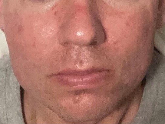 BBL Rosacea After