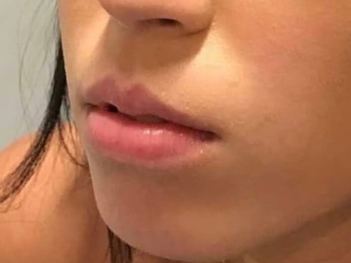 Juvederm Lip Enhancement Before