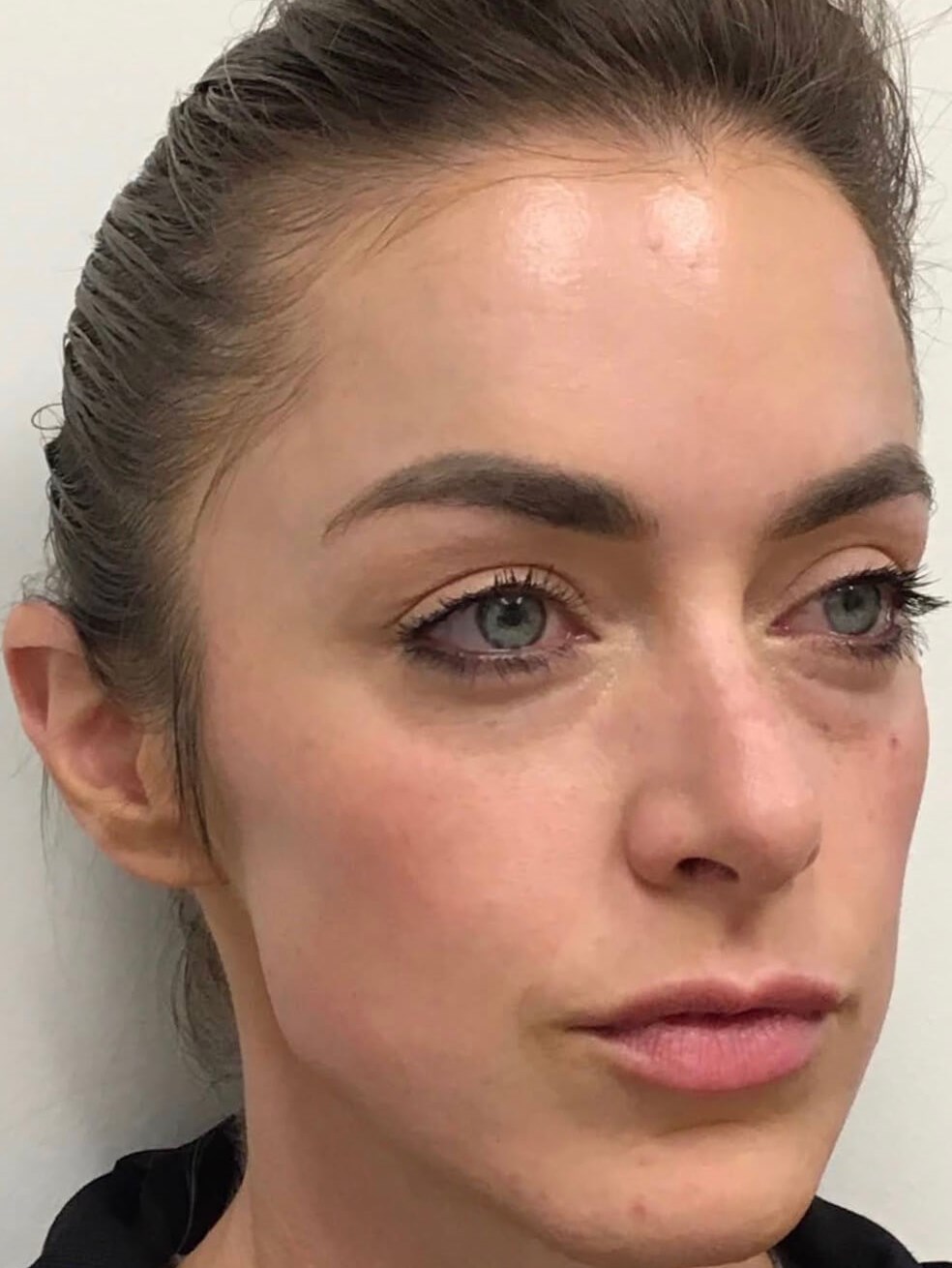 Restylane Cheek Fillers Before