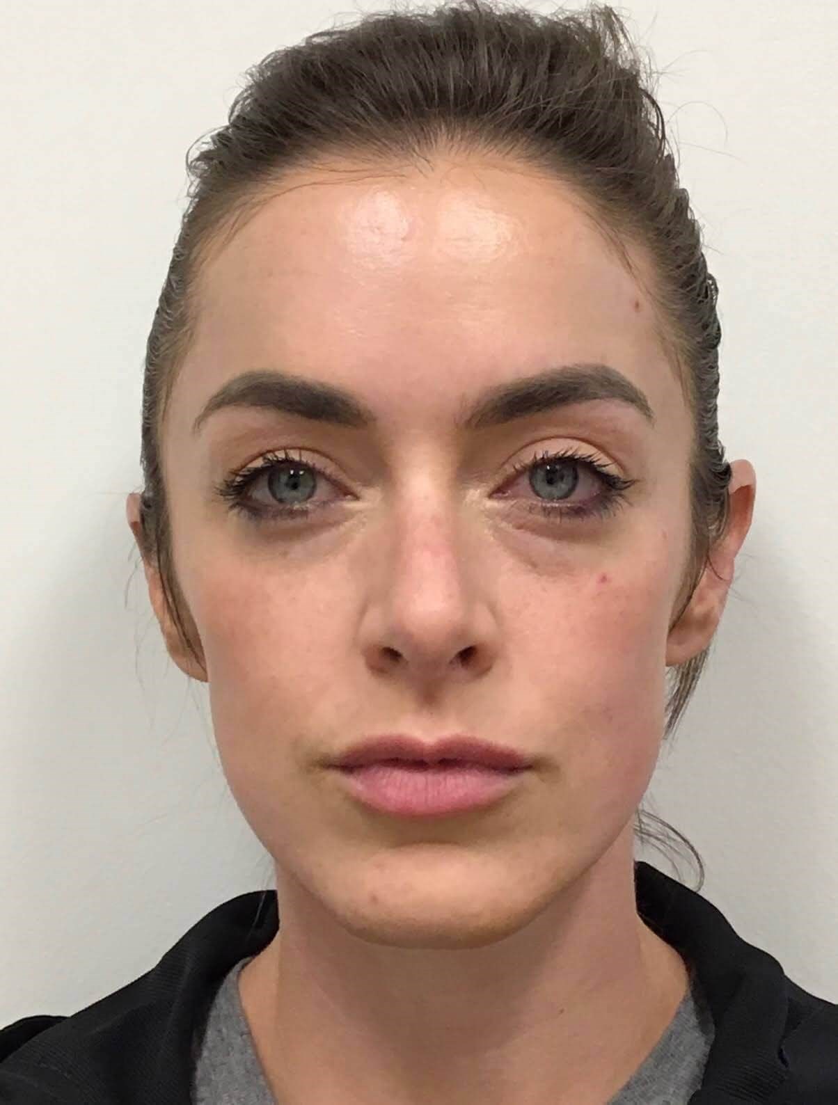 Restylane Cheek Filler Before