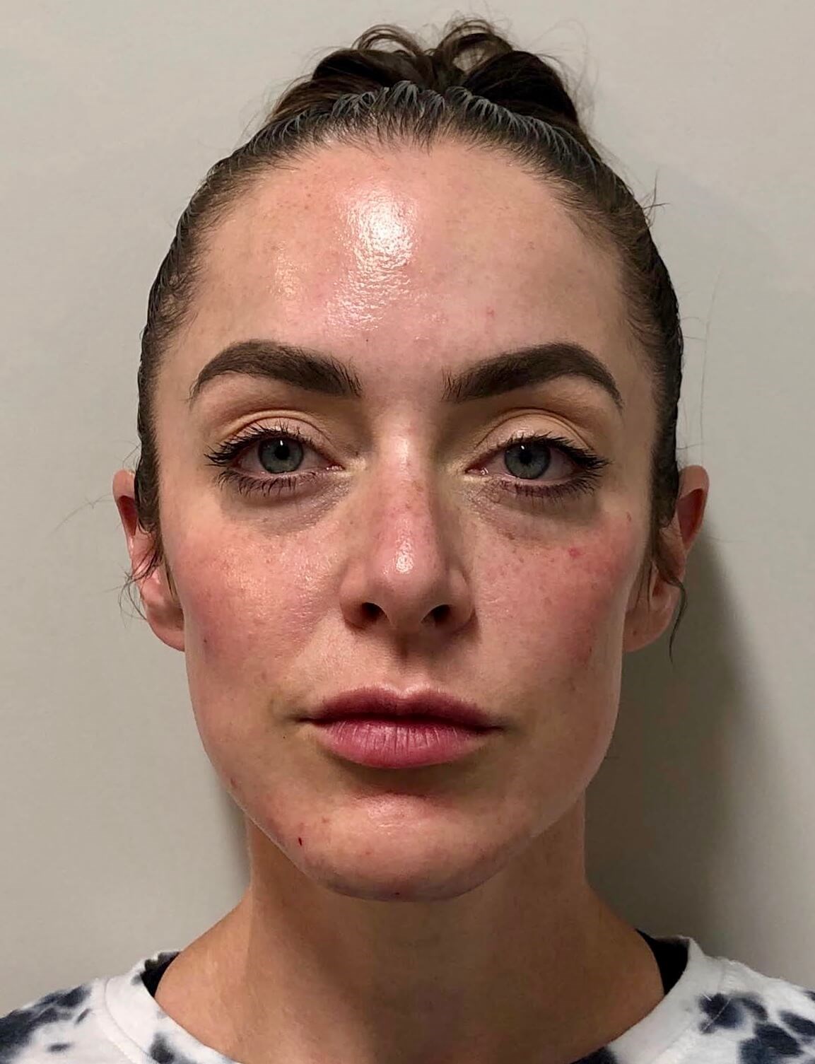 Restylane Cheek Filler After