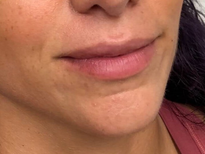 Juvederm Ultra Lips Female Before