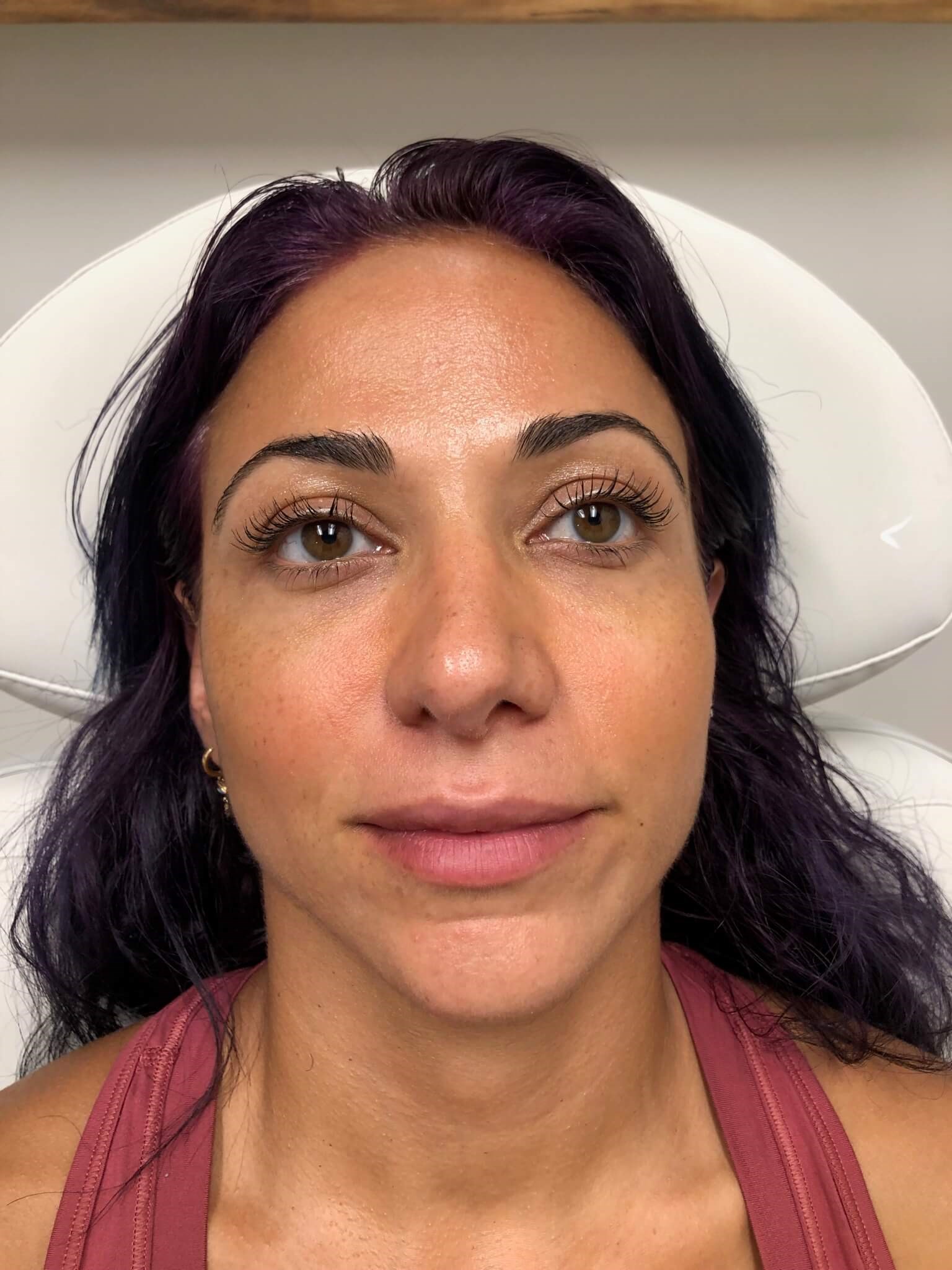 Juvederm Ultra Lips female Before