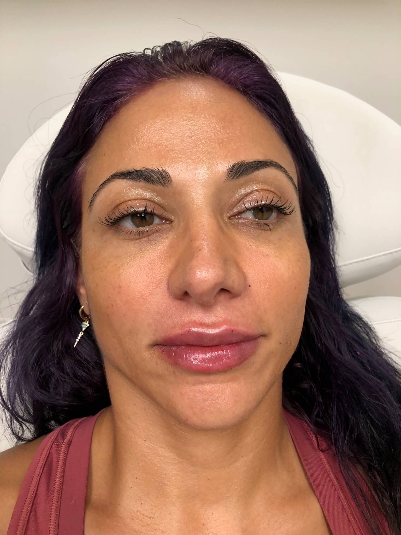Juvederm Ultra Lips female After