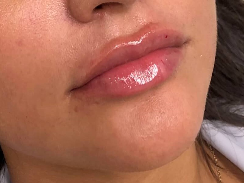 Restylane Kysse Lips After