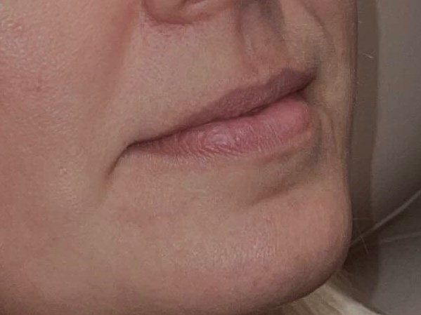 Restylane Kysse Lips Before