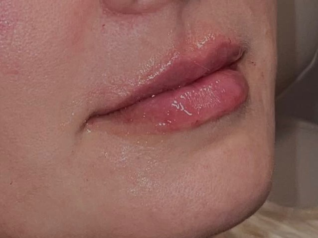 Restylane Kysse Lips After