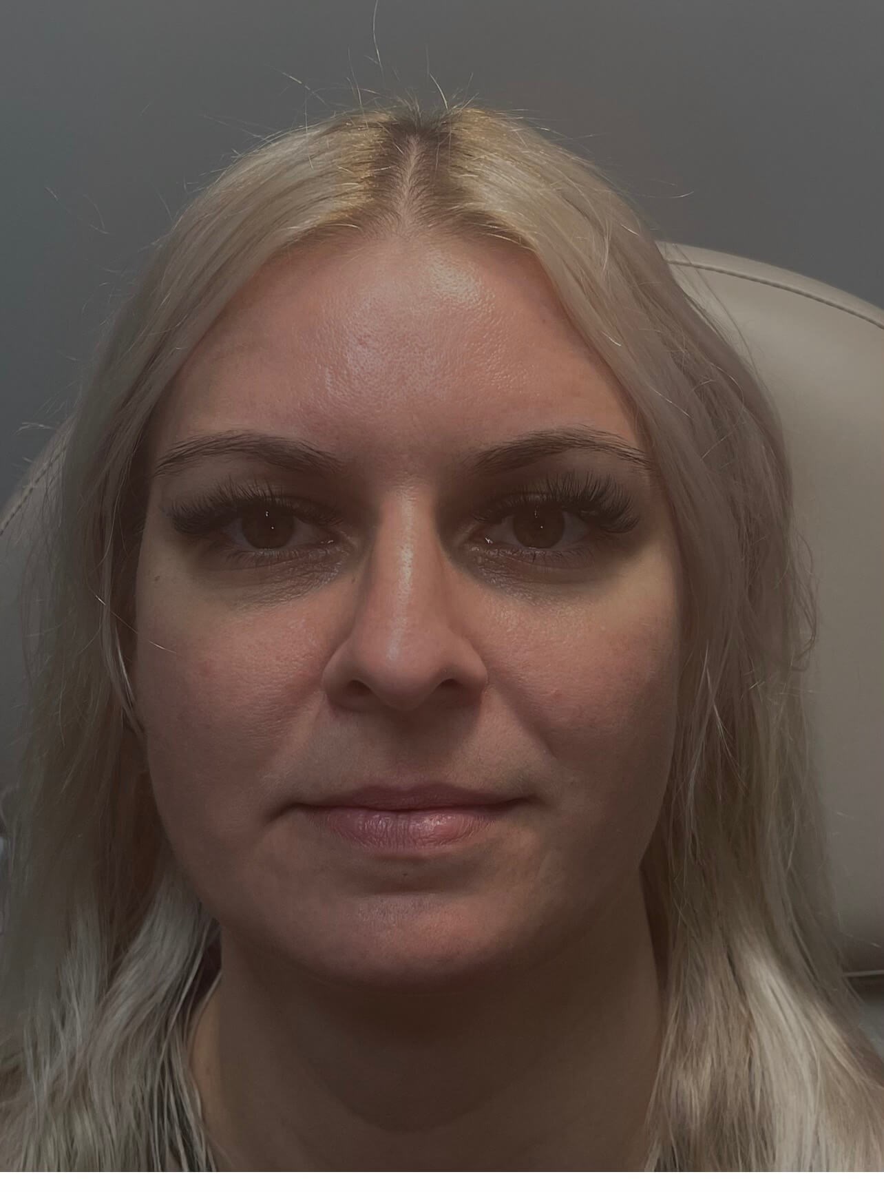 Restylane Kysse Lips Before