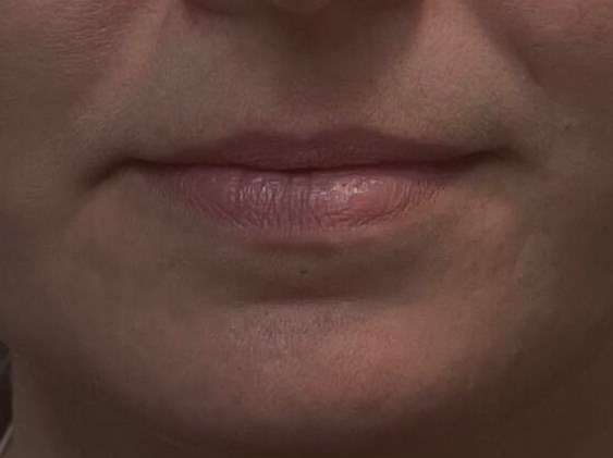 Restylane Kysse Lips Before