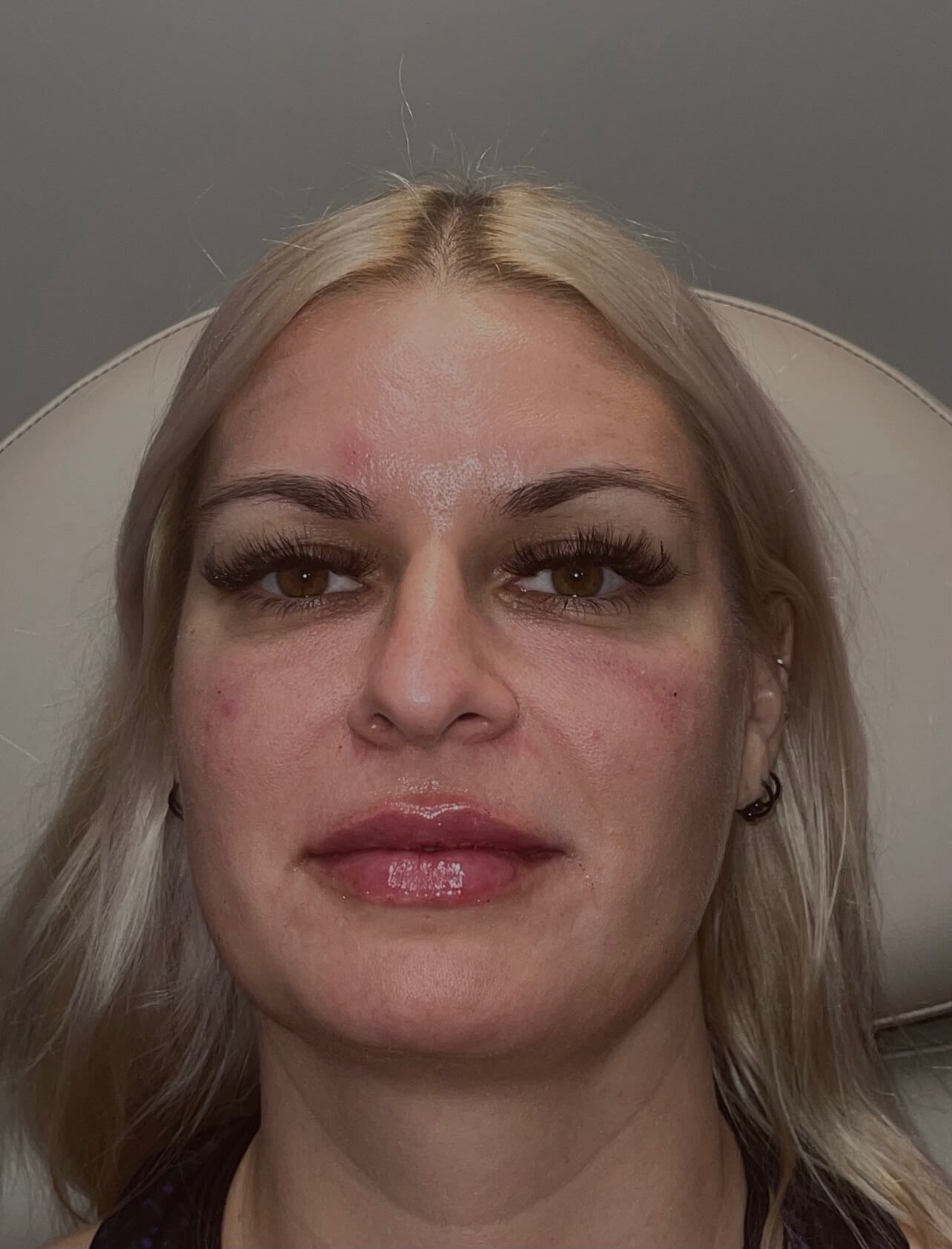 Restylane Kysse Lips After