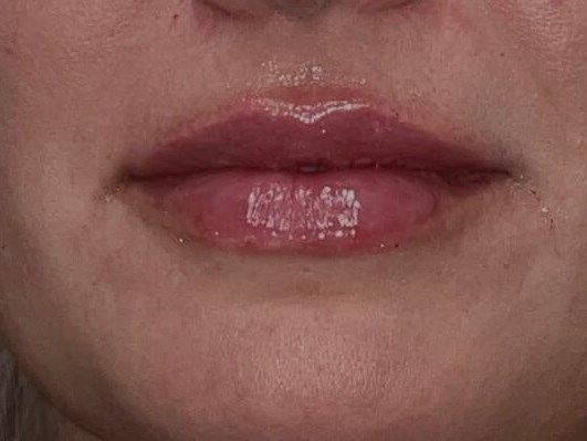 Restylane Kysse Lips After