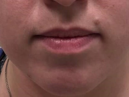 Juvederm Ultra Lip Fillers Before