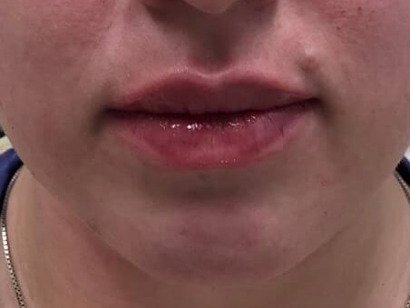 Juvederm Ultra Lip Fillers After