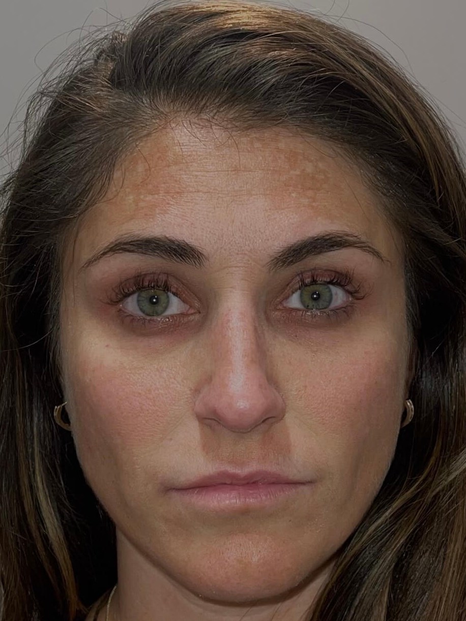 Restylane Kysse Lip Fillers Before