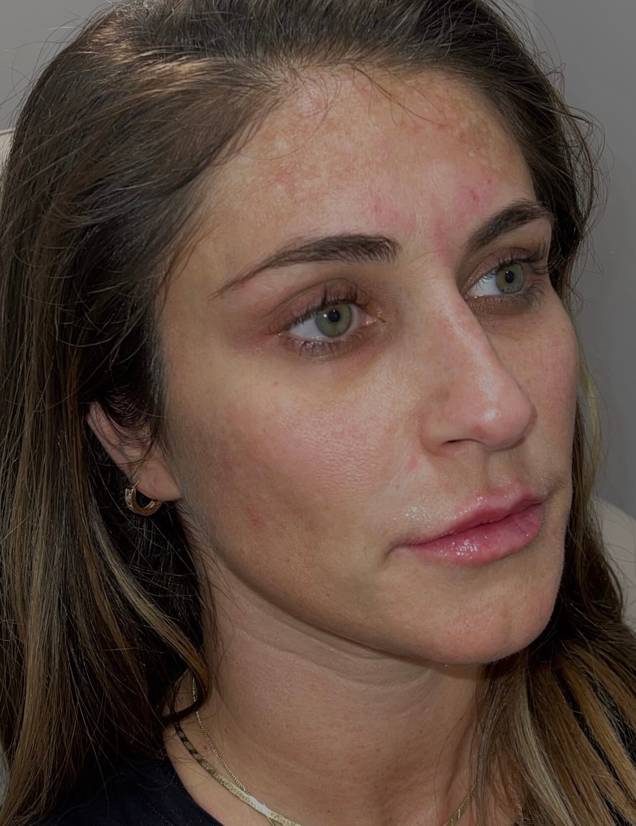 Restylane Kysse Lips After