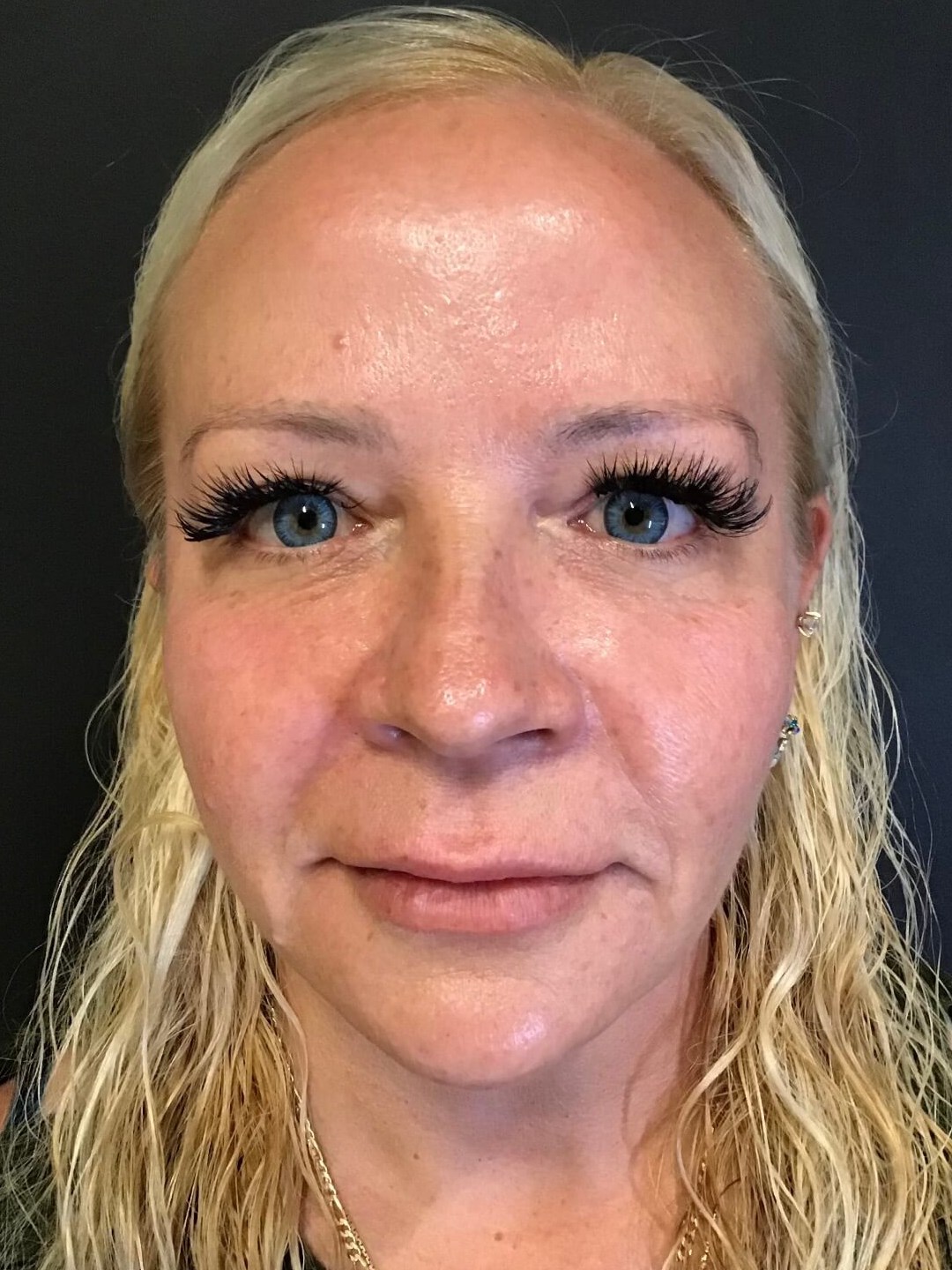 Sculptra Facial Enhancement Before
