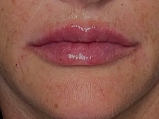 Female Restylane Kysse Lips After