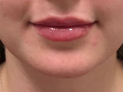 Juvederm Ultra lip fillers After