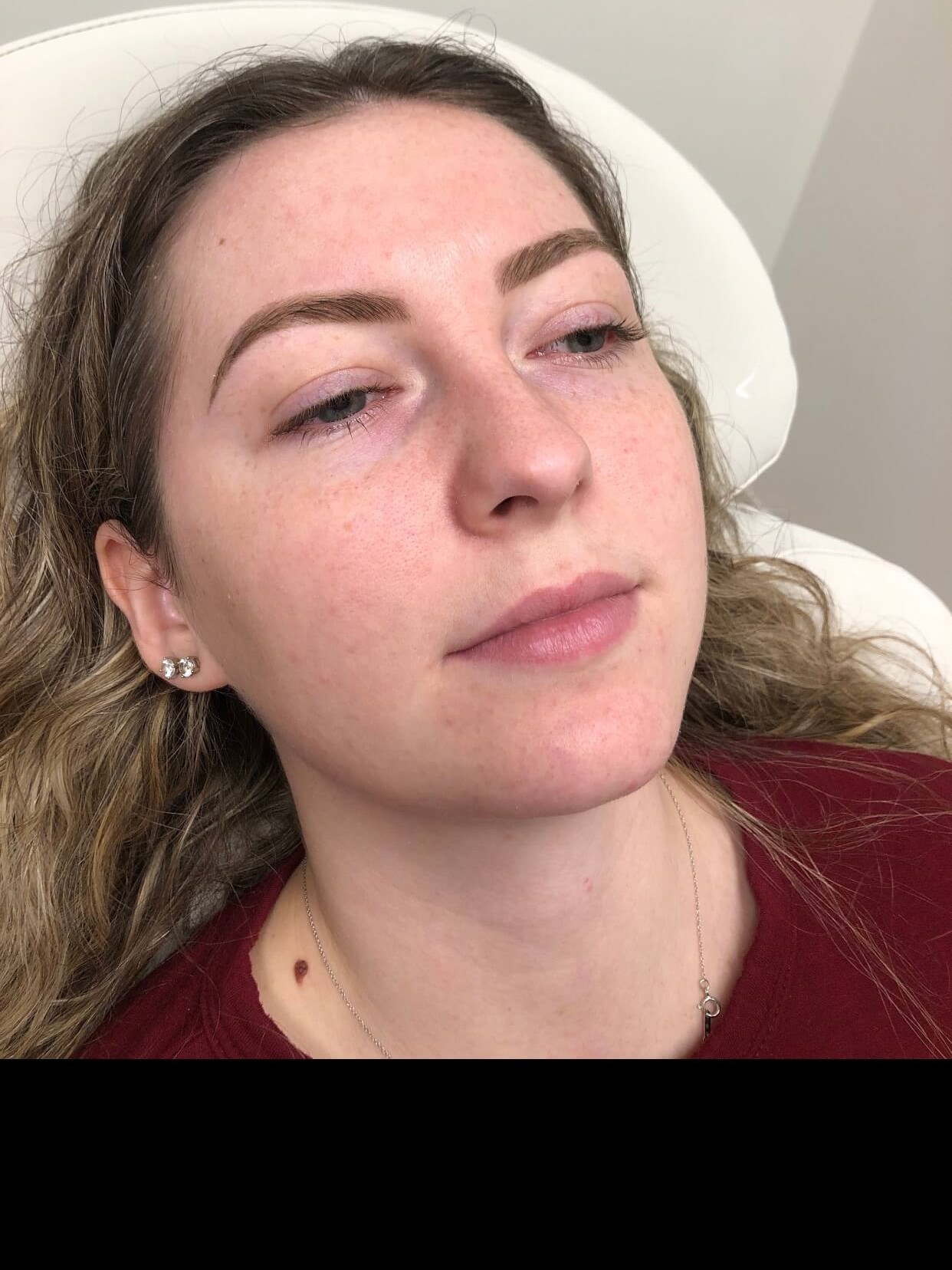 Juvederm Ultra lip fillers Before