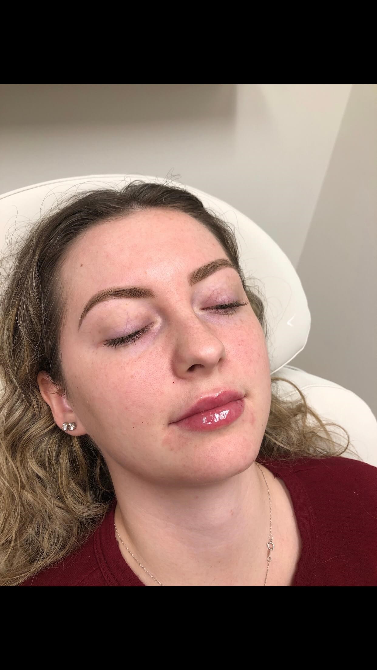 Juvederm Ultra lip fillers After