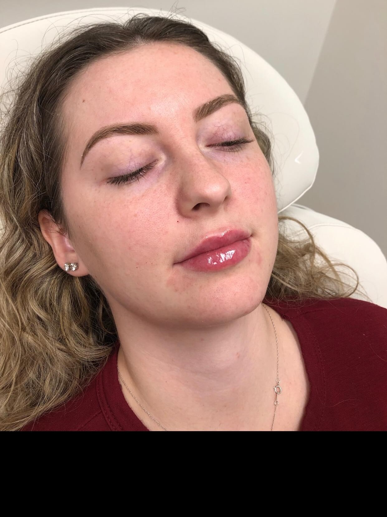 Juvederm Ultra lip fillers After
