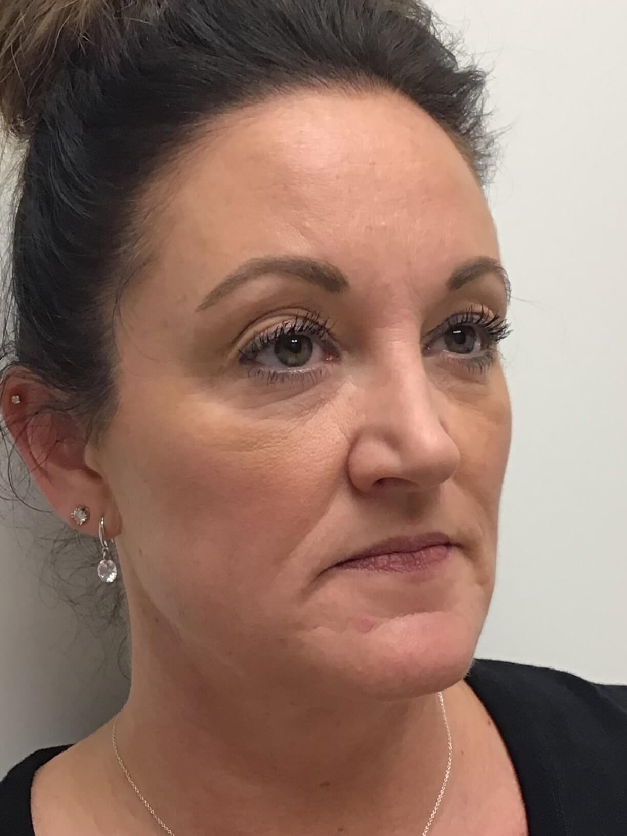 Juvederm Face Enhancement Before