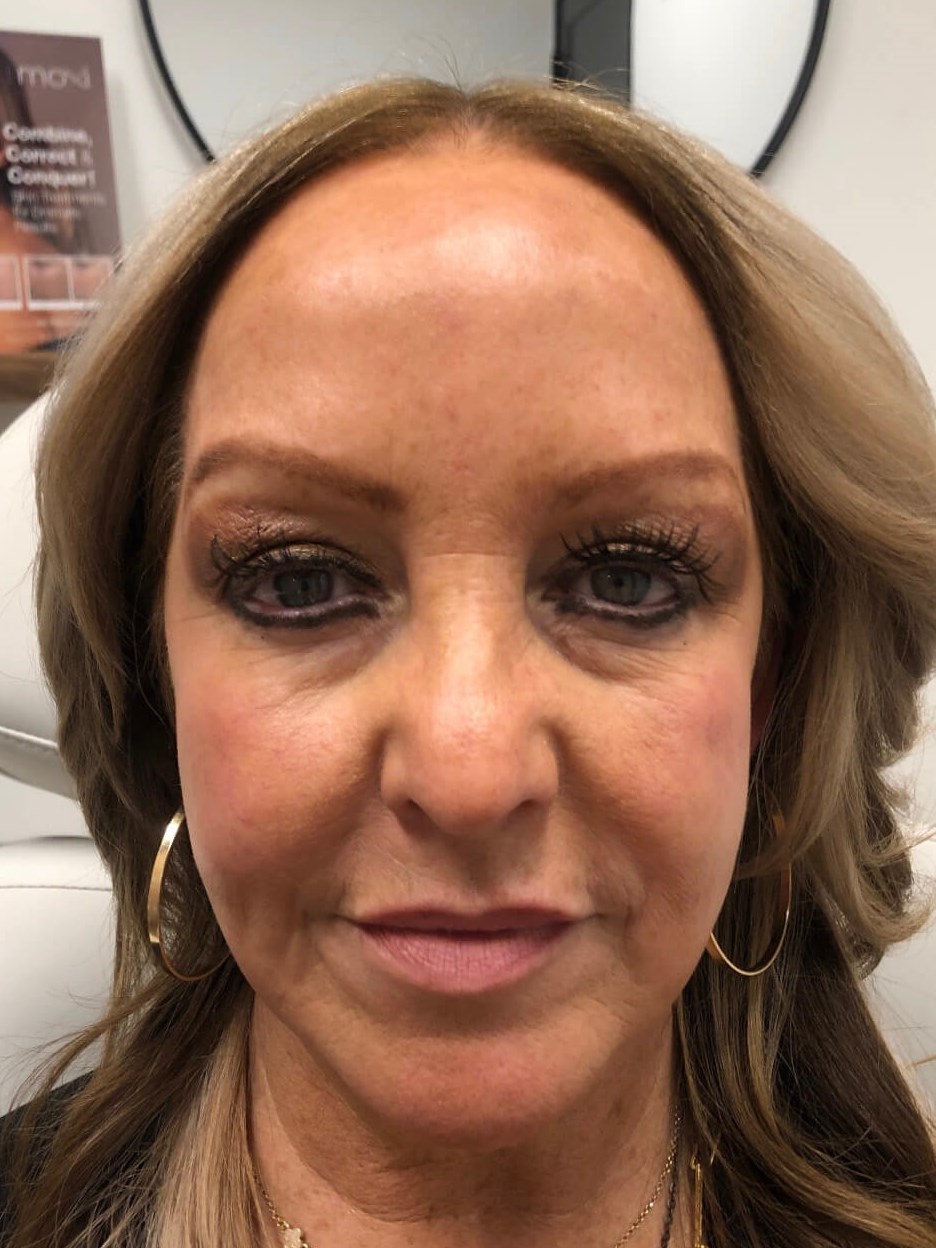 Juvederm Face Enhancement Before