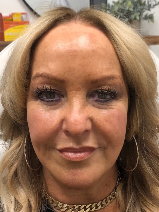 Juvederm Face Enhancement After