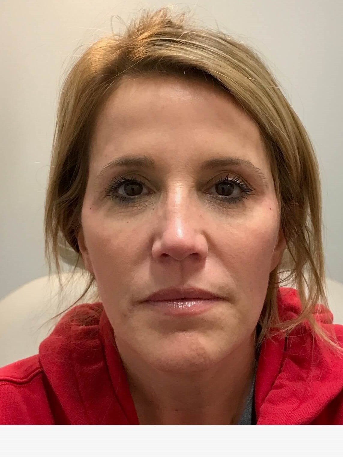 Juvederm Face Enhancement After