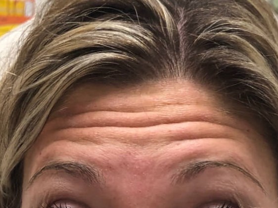 botox forehead Before
