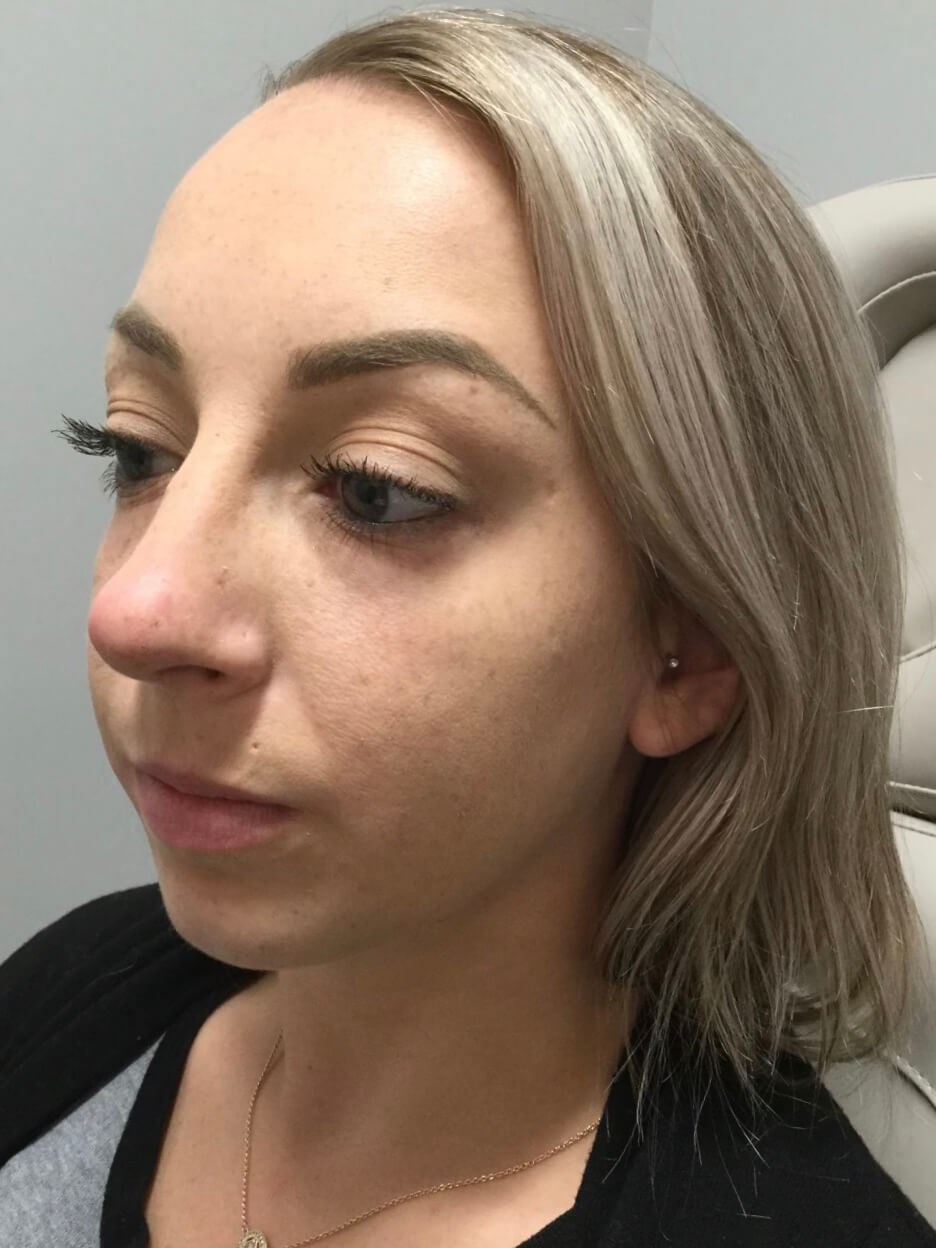 Juvederm Chin Enhancement Before