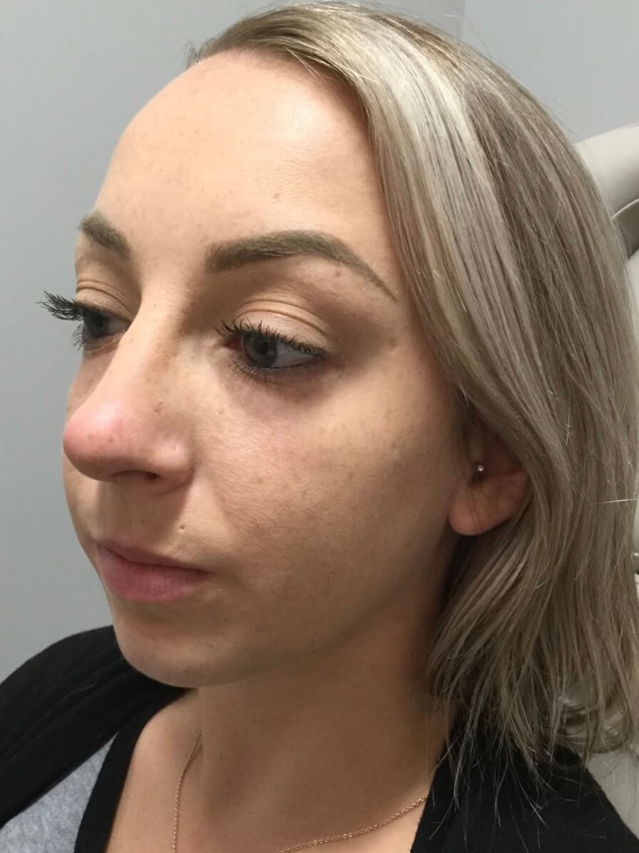 Juvederm Chin Enhancement Before