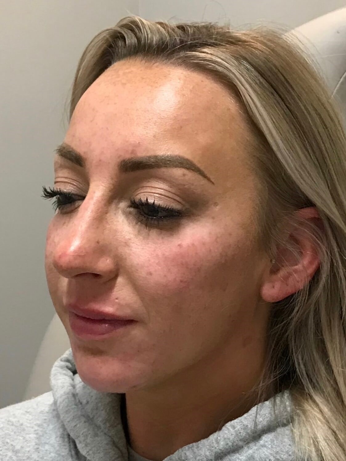 Juvederm Chin Enhancement After