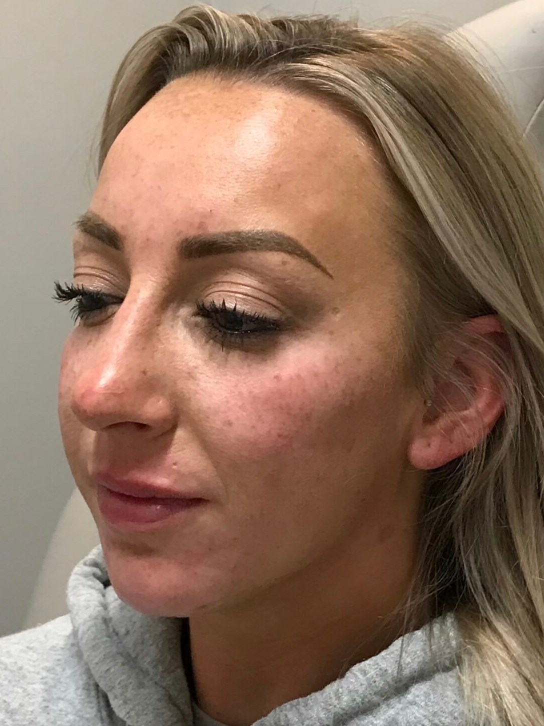 Juvederm Chin Enhancement After