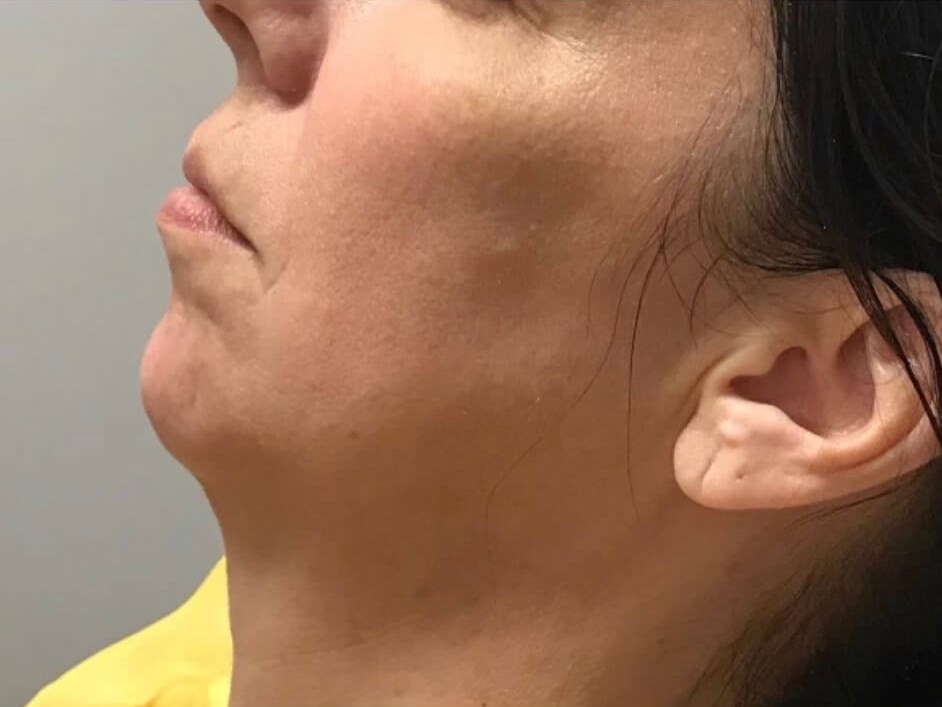 Juvederm Chin Enhancement Before